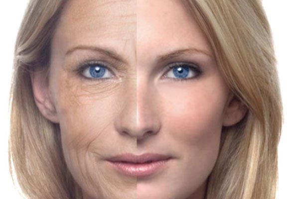 Ageing (Lines & Wrinkles)
