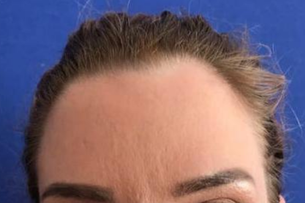 Botox-Forehead-After-Image.png