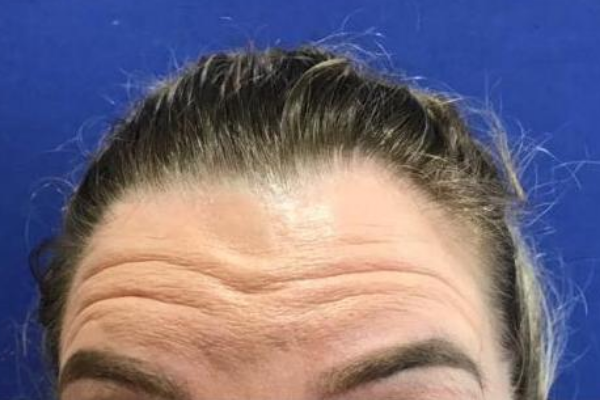 Botox-Forehead-Before-Image.png