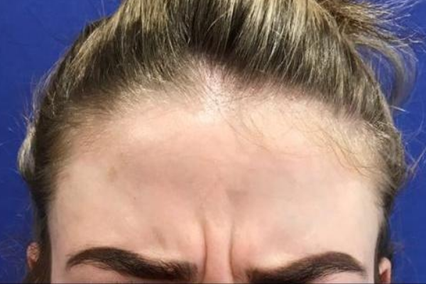 Botox-Glabella-Before-Image.png